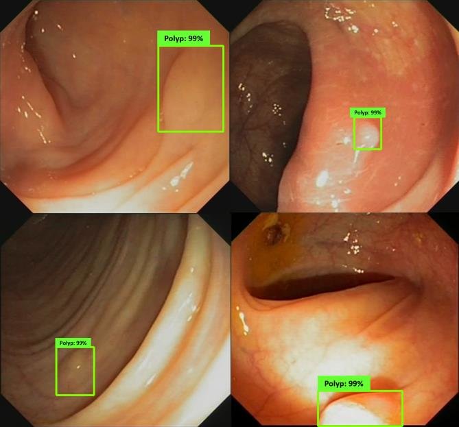 Colonoscopic Polyp Detetction thumbnail