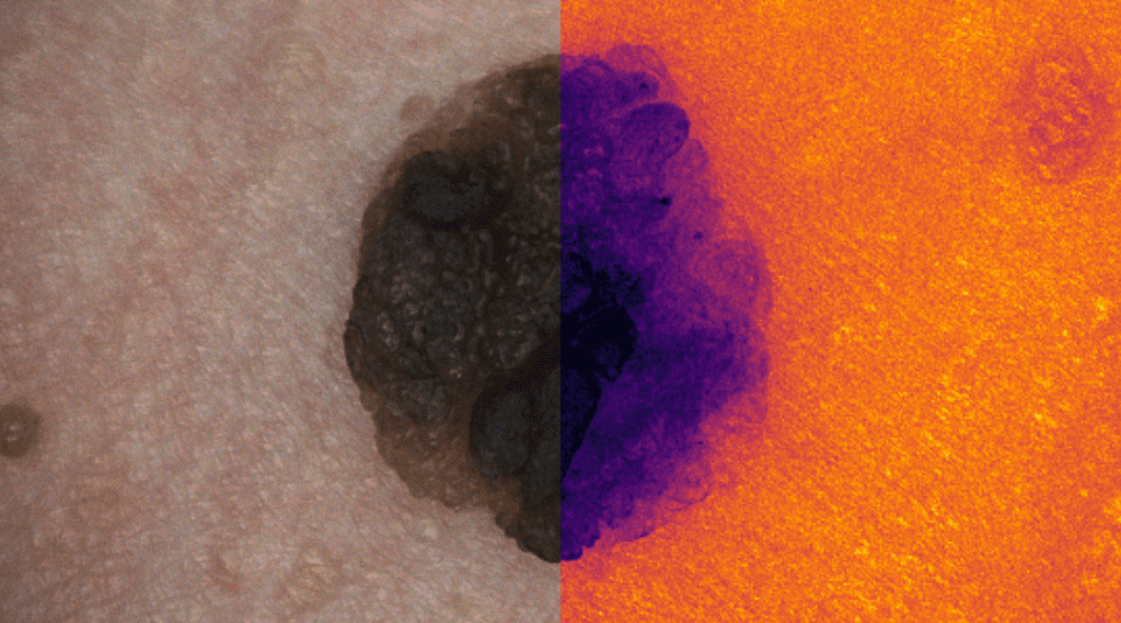 Skin Cancer Detection thumbnail